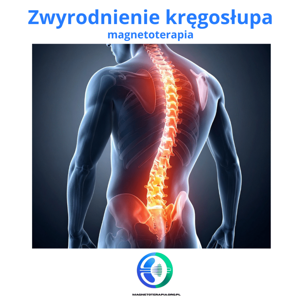 zwyrodnienie kręgosłupa